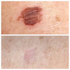 Age spots before and 4 weeks after cryo