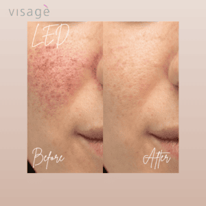 LED Light therapy before and after