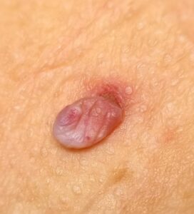 Skin tag
