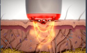 Radiofrequency with Apollo duet