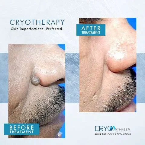 beforeandafter-cryotherapy2