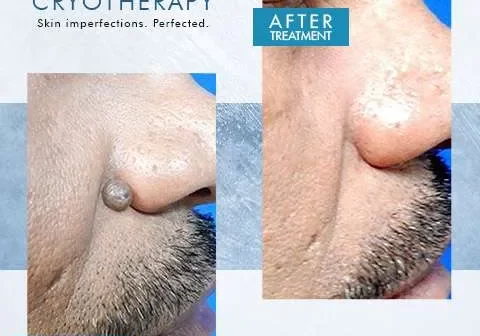 beforeandafter-cryotherapy2